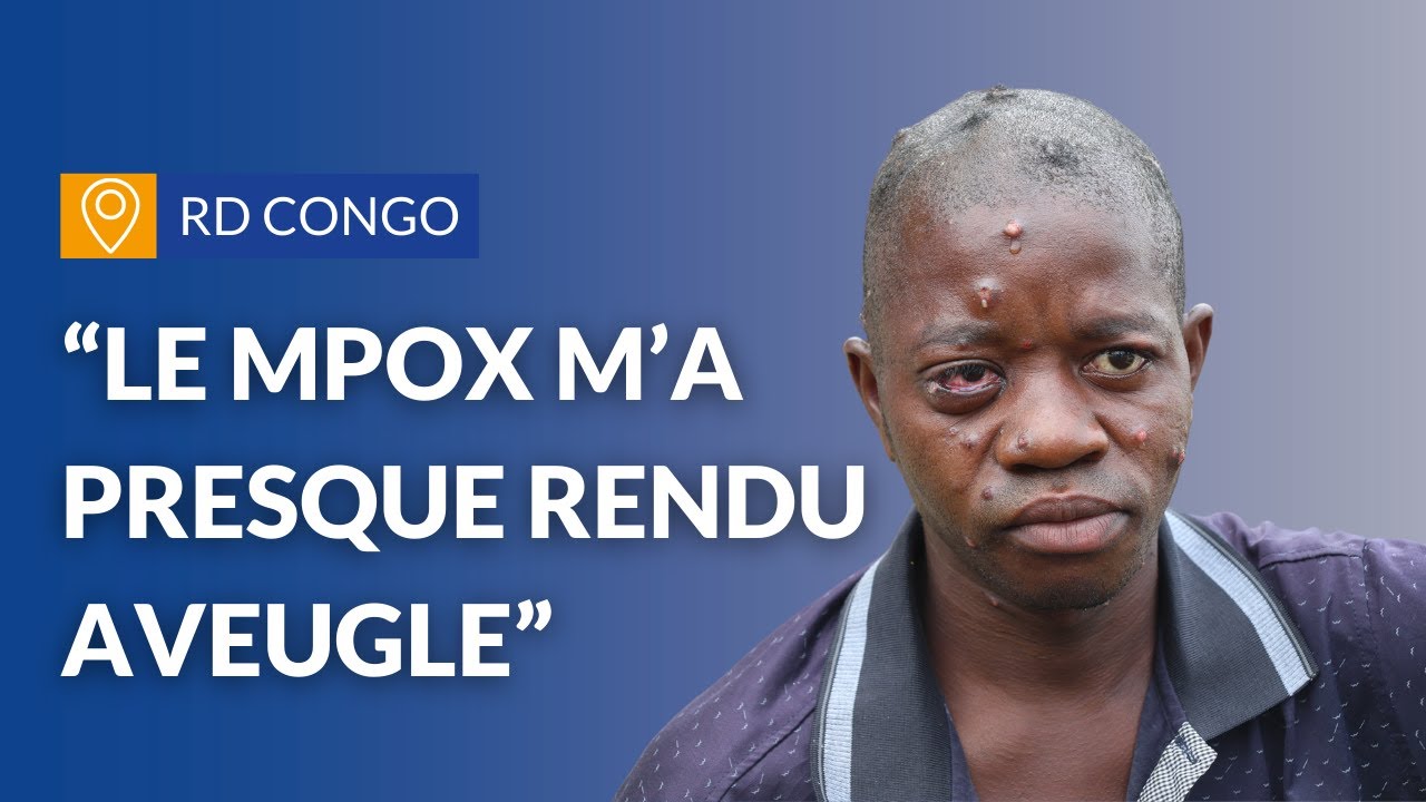 "Le Mpox m'a presque rendu aveugle" | RD CONGO | ALIMA